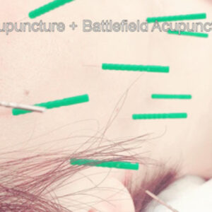 Cosmetic Acupuncture + Battlefield Acupuncture（美顔鍼+バトルフィールド鍼灸）　レビュー